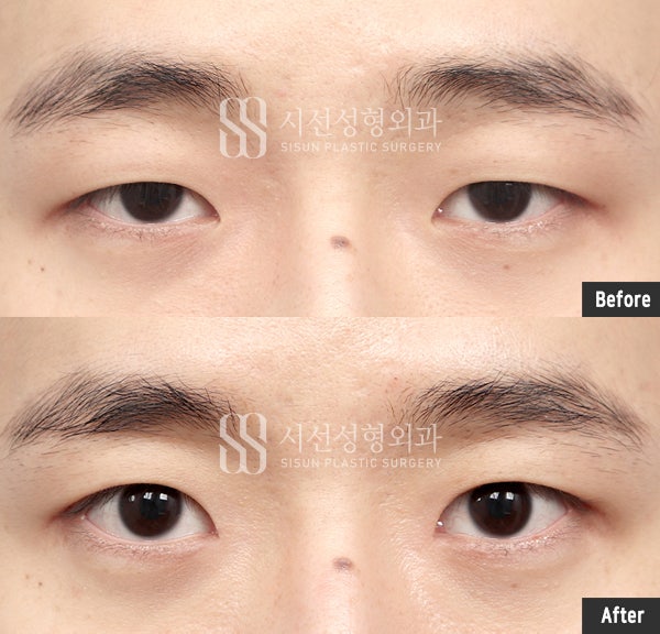 남자무쌍눈매교정 자연스럽게 안검하수 개선을 원한다면