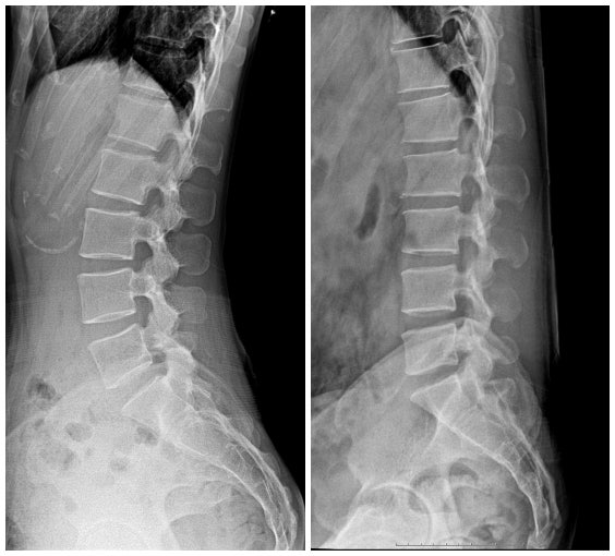 일자허리란? - 요추 후만(lumbar kyphosis) : 네이버 블로그