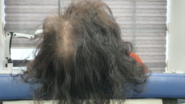  왜관 탈모 치료 병원 어떻게 극복 해야 할까요?
