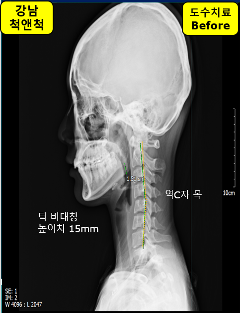 (강남역 도수치료) 중학생 두통과 피로감(안면비대칭, 역C목 척추측만증) 하악관절+척추마사지가 필요합니다. 2