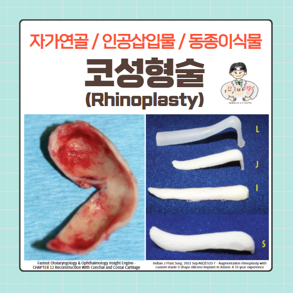  코성형술(Rhinoplasty) (3) - 자가연골, 인공삽입물, 동종이식물