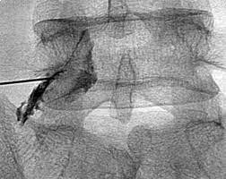 경추간공 경막외 스테로이드 주사(TransForaminal Epidural Steroid Injection, TFESI ...