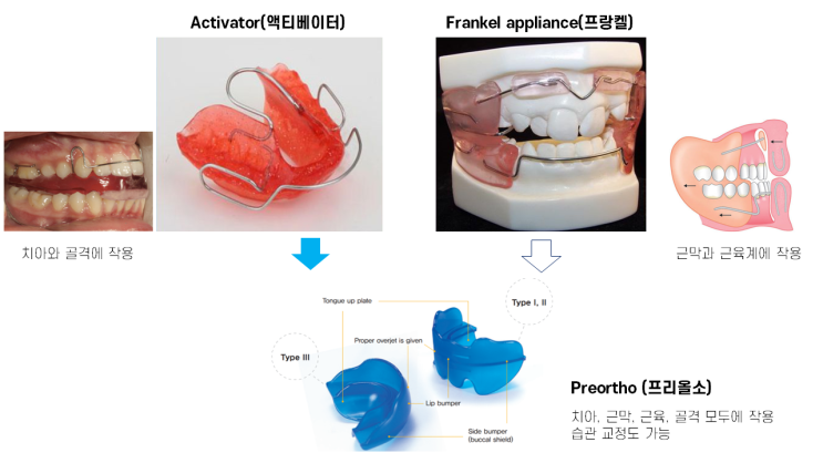 어린이 부정교합 교정은 프랑켈 장치 치료에서 프리올소(근기능장치) 치료로 진화되고 있다.