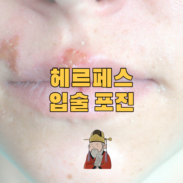  헤르페스 입술 포진 치료 과정 및 후기 아시클로버