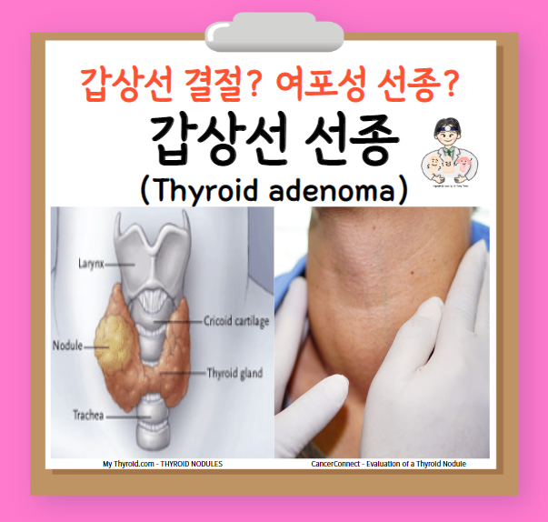  갑상선 선종(thyroid adenoma), 중독성 갑상선 선종(toxic thyroid adenoma)