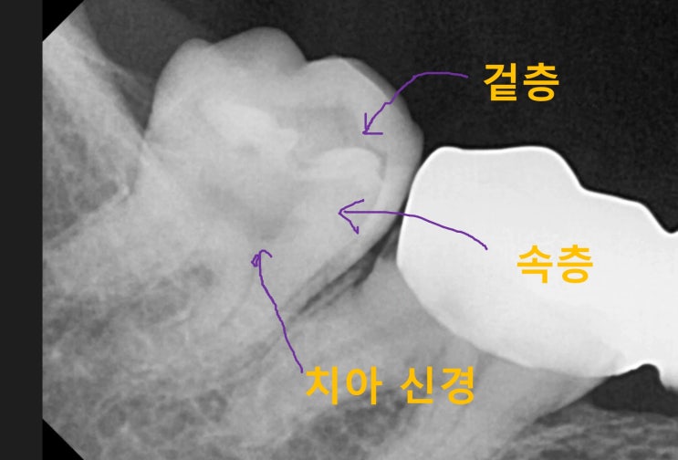 미사치과 신경치료는 치과보존과 전문의에게