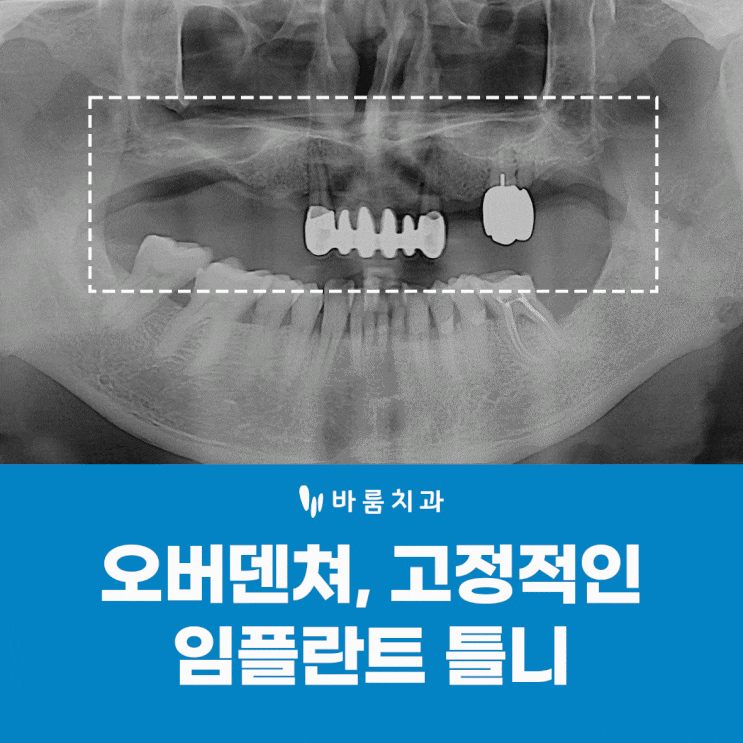  양산물금치과 전체 임플란트 틀니 장단점 기간 (ft.오버덴쳐)