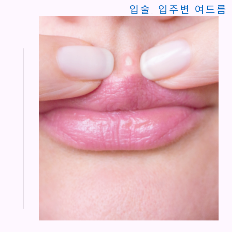 입술 여드름 입주변 여드름 원인 및 관리 방법 입술 여드름 입주변 여드름 원인 및 관리 방법