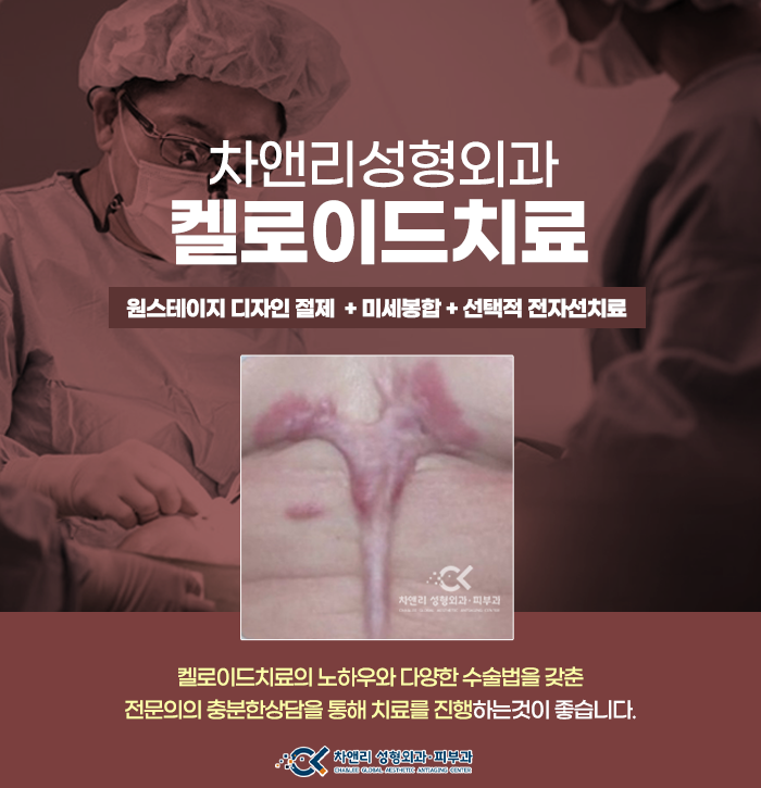  켈로이드치료시에 절제수술 쉽게 생각하지마세요.