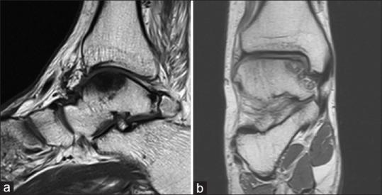  발목 삐끗, 한달이 지났는데도 지속되는 통증 [부전역, 부전동 정형외과,한의원]