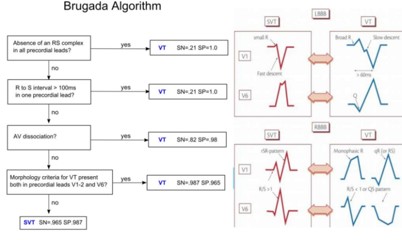 Wide QRS complex tachycardia 감별 기초 : 네이버 블로그