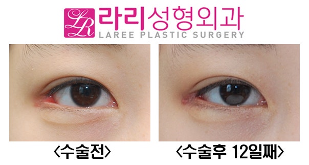 라리성형외과] 다양한 뒤트임복원수술 전후사진 : 네이버 블로그