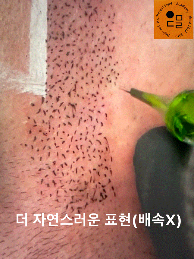  울산smp 잘하는곳 우두머리에서 탈모두피해결