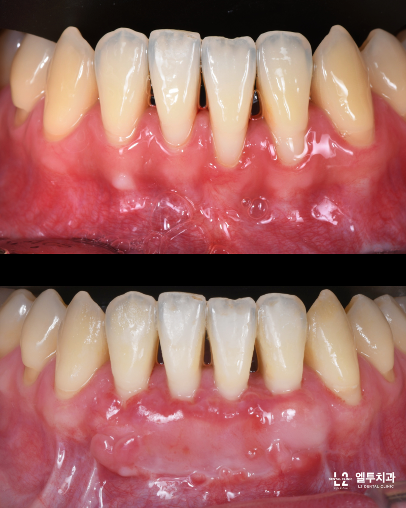 치아교정 부작용 잇몸퇴축(=잇몸내려앉음) 회복을 위한 잇몸재생 치료(=치은이식)에 대하여, 강남구 치과 : 네이버 블로그