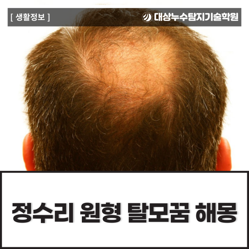 정수리 원형 탈모꿈 해몽 궁금하다면