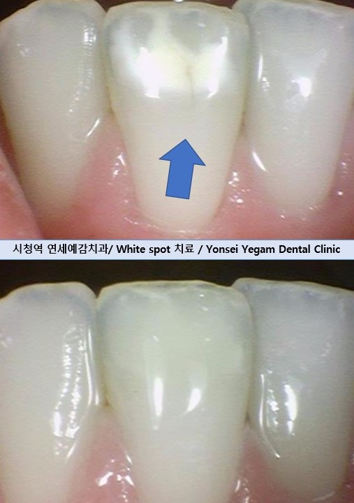 [Seoul/ English speaking dentist] Treatment: White spots, White Stain on teeth