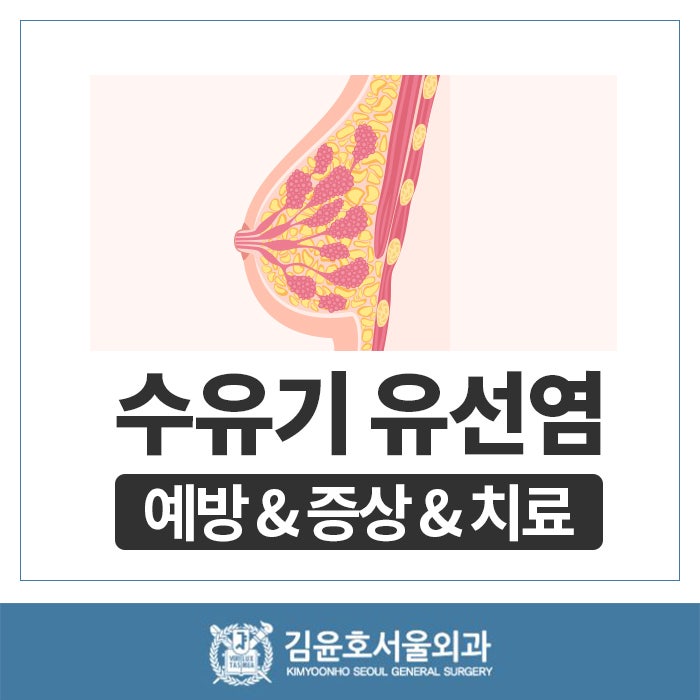 유방염 증상이 있어도 모유 수유를 할 수 있습니까? 1