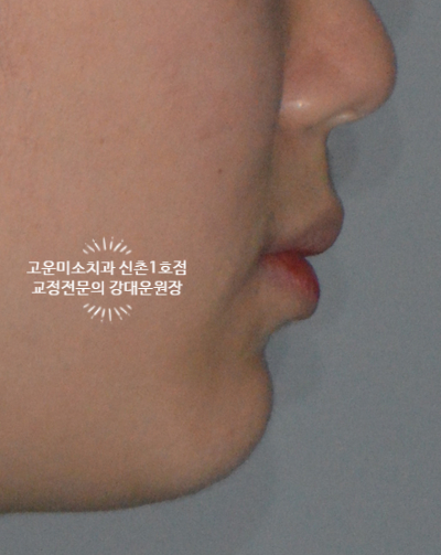  윗니돌출 총생 미세돌출 불규칙한치열 개선 신촌교정전문의 고운미소 신촌1호점 치료증례