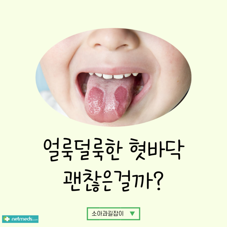  지도상 혀, 갑자기 아이 혓바닥이 얼룩덜룩해요!!! 왜 이런 거죠? 뭐를 발라야 하나요??