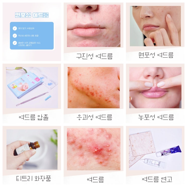 구진성 응괴성 농포성 면포성 여드름 원인 및 케어 방법 구진성 응괴성 농포성 면포성 여드름 원인 및 케어 방법