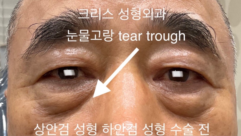 압구정역 성형외과 하안검 수술 비용과 방법, 부작용까지