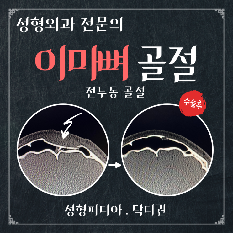  [전두동 골절] 이마뼈 골절에 대해 알아봅시다. (feat. Frontal sinus fracture)