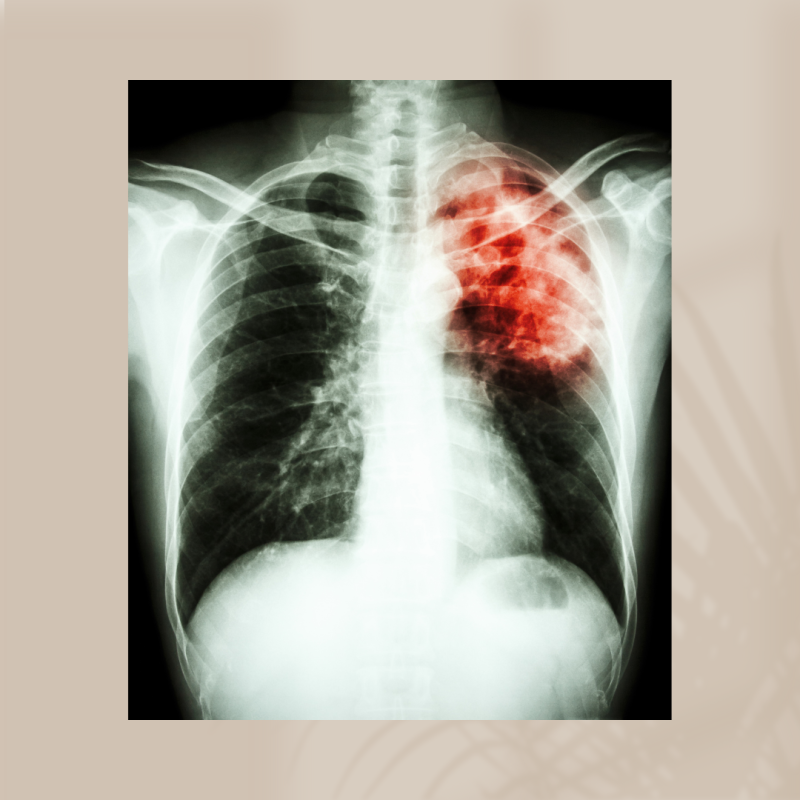 폐 결핵 원인 증상 치료 전염 tuberculosis : 네이버 블로그