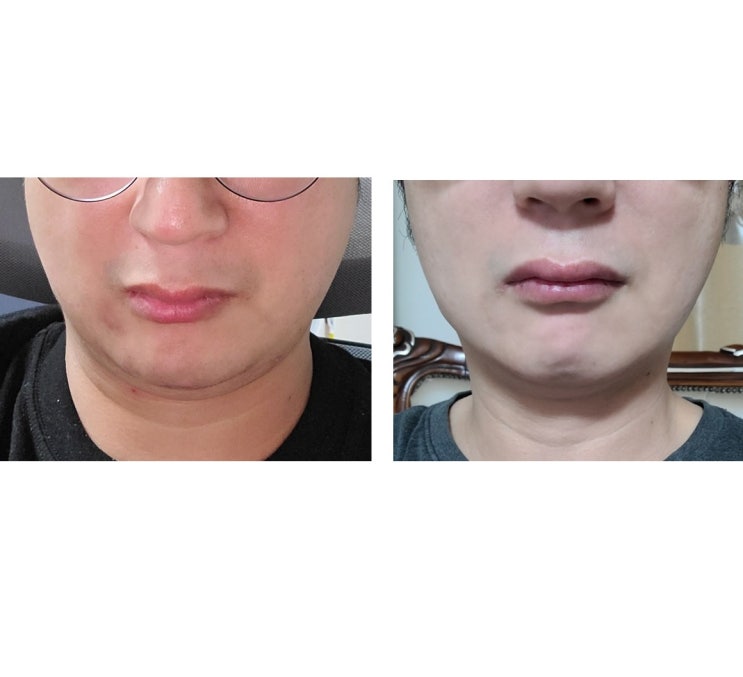  턱살제거 완벽 해결 방법 알려드림