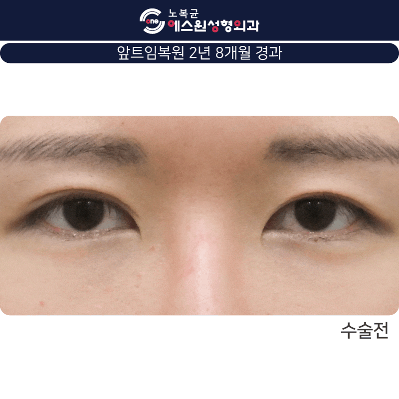 안각재건술을 고려하고 계시다면 압구정성형외과 3