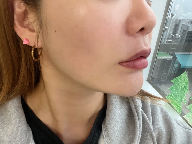 신논현피부과, 인모드리프팅 얼굴윤곽관리하기 ~