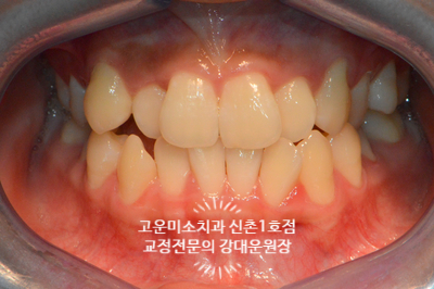  치열불규칙 총생 주걱턱 경향 비발치교정치료 신촌교정치과 고운미소신촌1호점 증례