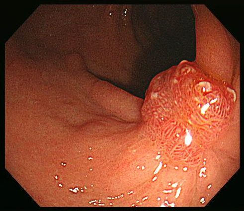  내시경적 점막하 박리술 후 융기형 반흔 내시경 소견 Endoscopic findings after ESD