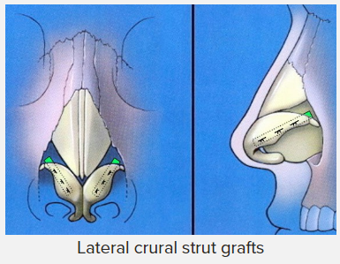 코성형술(Rhinoplasty) (5) - 코끝(비첨) 성형술(nasal tip plasty) - 연골봉합, 연골이식 : 네이버 블로그