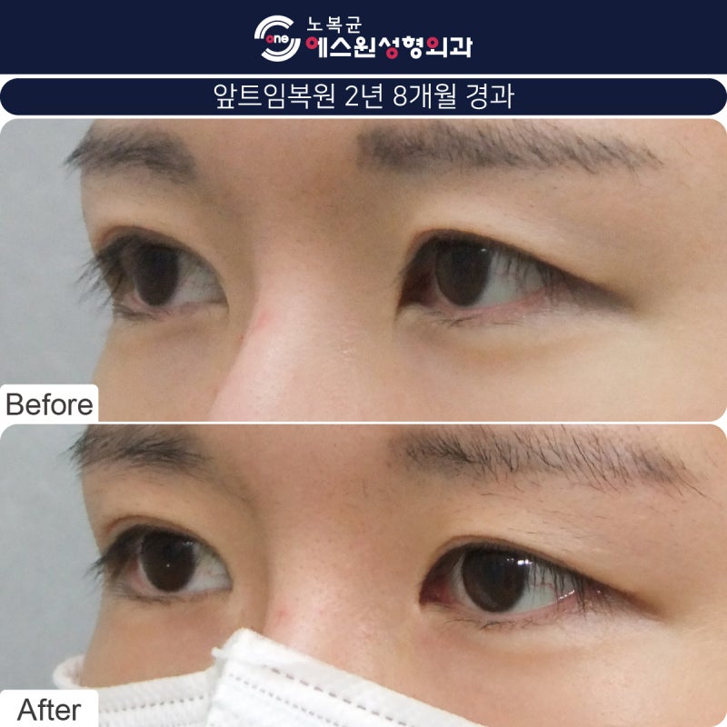 안각재건술을 고려하고 계시다면 압구정성형외과 2