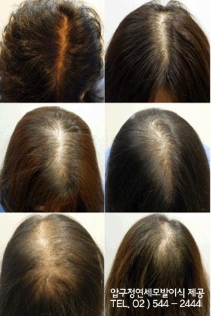 여성탈모치료병원 1:1 맞춤 상담