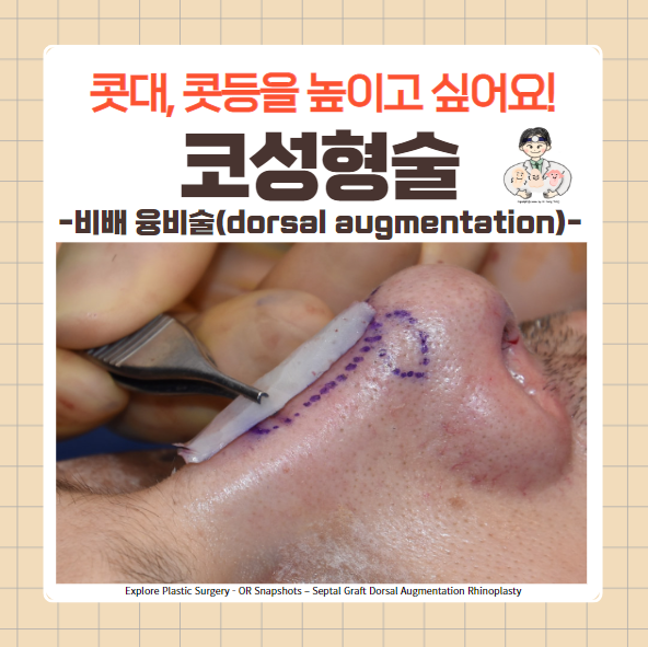  코성형술(Rhinoplasty) (4) - 콧등(콧대, 비배) 융비술(dorsal augmentation), 비근부 융비술(radix augmentation)