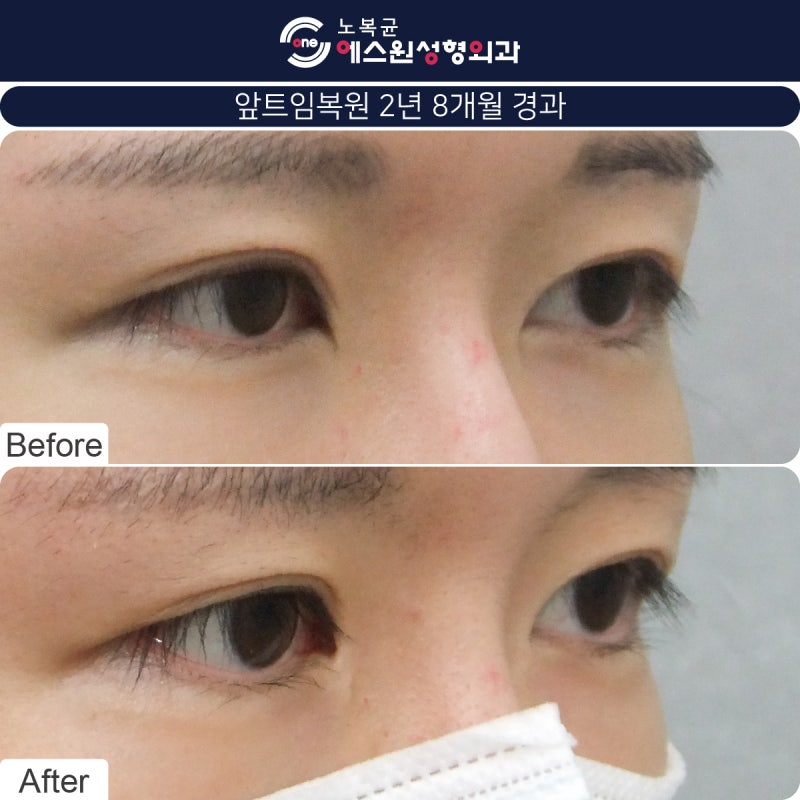 안각재건술을 고려하고 계시다면 압구정성형외과 1