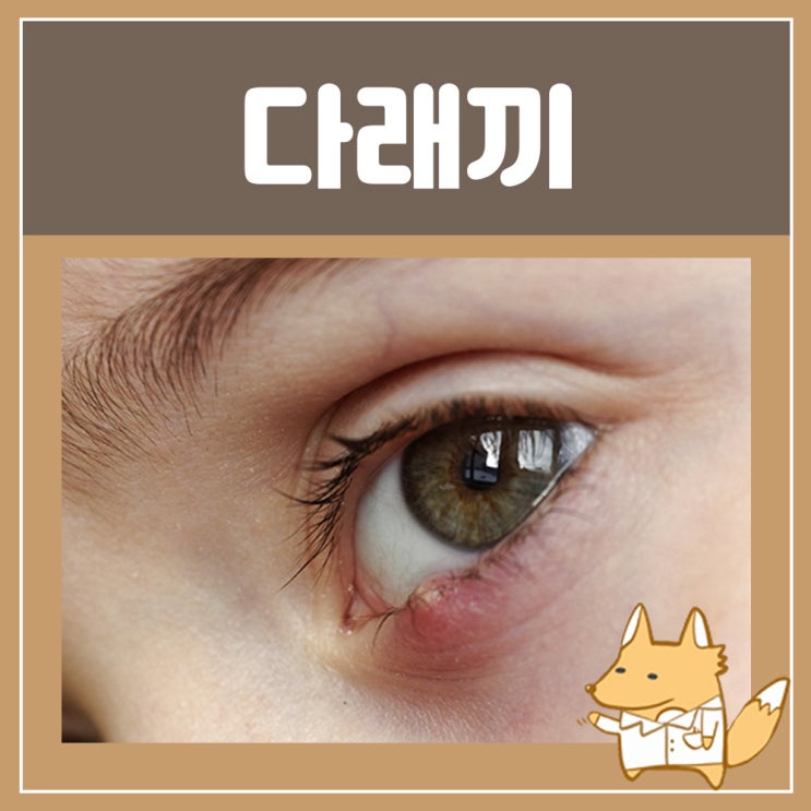  약국 다래끼약 타리비드 안연고 마이노신 눈 다래끼 전염 초기증상 원인 치료 안약 콩다래끼 증상