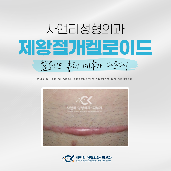  제왕절개 켈로이드 비후성반흔 제거하려면