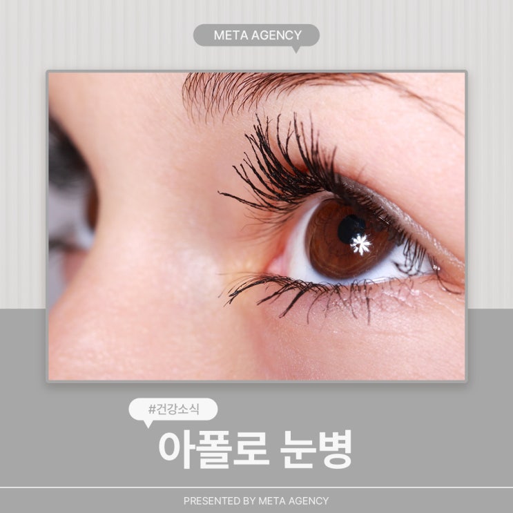  전염성 높은 아폴로 눈병의 증상과 주의사항, 대처방법