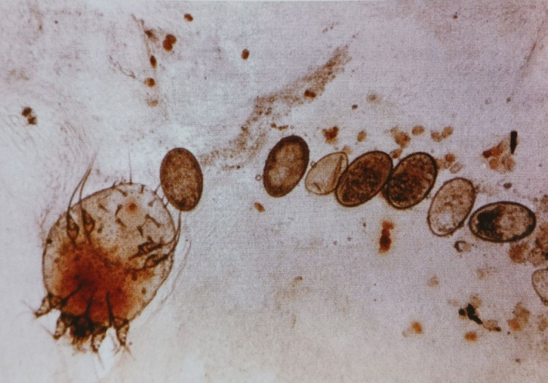 옴(Scabies) / 피부과 최달용 과장 : 네이버 블로그
