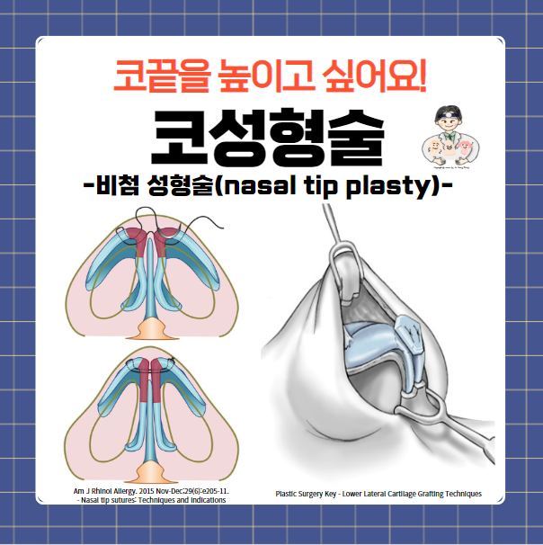  코성형술(Rhinoplasty) (5) - 코끝(비첨) 성형술(nasal tip plasty) - 연골봉합, 연골이식