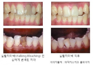  실활치 치아미백 ‘워킹블리칭’ 아세요?