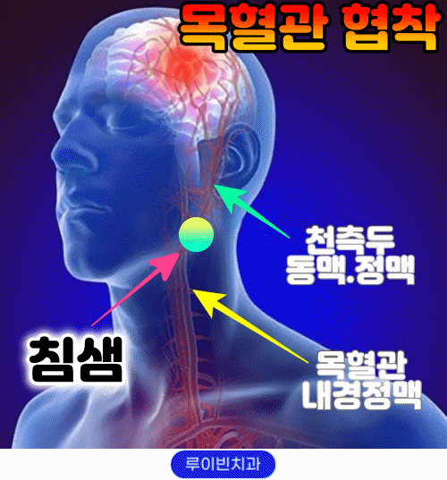 일자목통증 오른쪽 왼쪽 목어깨 두통까지 생긴다면?