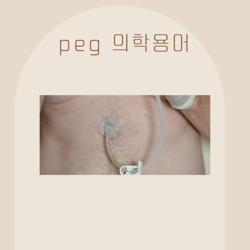 의학용어 PEG 경피적 내시경 위루술 목적과 합병증 주의점 : 네이버 블로그