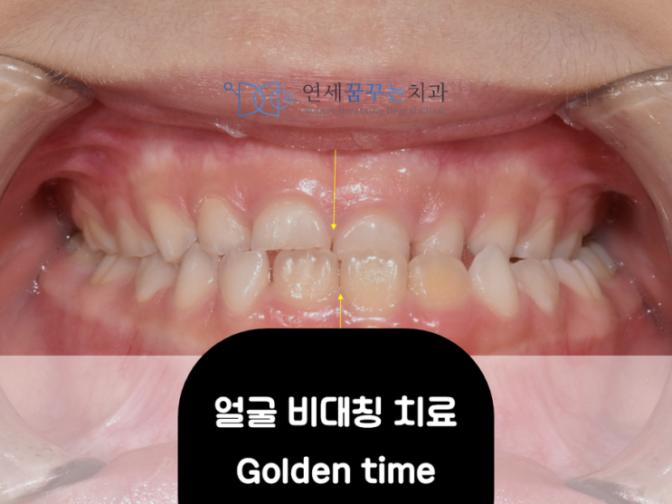 얼굴 비대칭 잡아주는 급속구개확장 치료 & 프리올소(근기능장치)