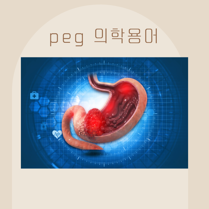 의학용어 PEG 경피적 내시경 위루술 목적과 합병증 주의점 : 네이버 블로그