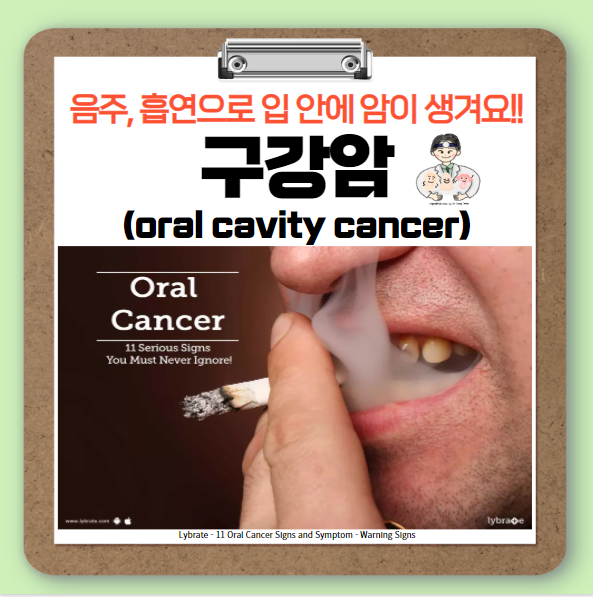  구강암(oral cavity cancer) (1) - 해부학적 구조, 역학, 원인, 병리학적 특징