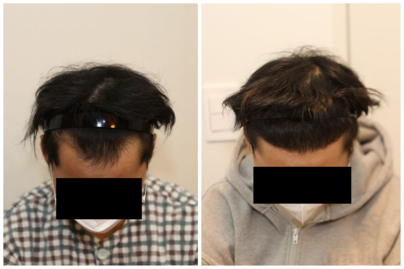 20대모발이식 후기, A~Z