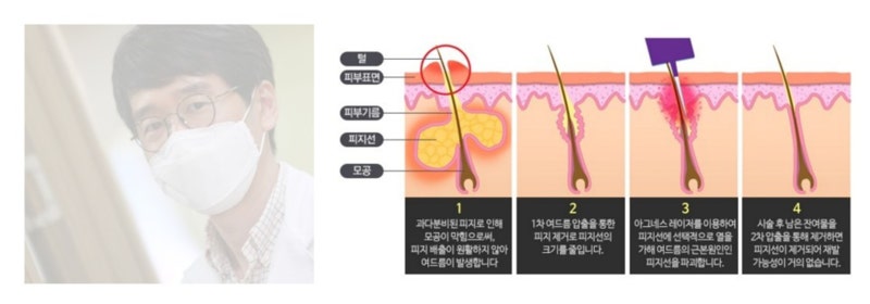 정적 자동 여드름 레이저 아그네스로 피지선 캡처 – 비타민 클리닉